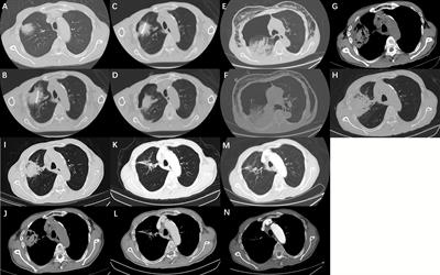 Local ablation of pulmonary malignancies abutting pleura: Evaluation of midterm local efficacy and safety